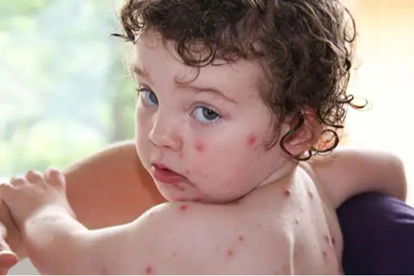 10 குழந்தைகளுக்கு தக்காளி காய்ச்சல் அறிகுறி….. வெளியான முக்கிய தகவல்….!!!!