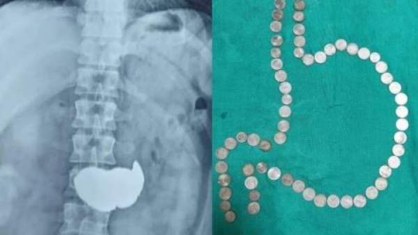 வயிற்றில் 63 நாணயங்கள்…. ஷாக்கான மருத்துவர்கள்…. பெரும் அதிர்ச்சி சம்பவம்…..!!!!