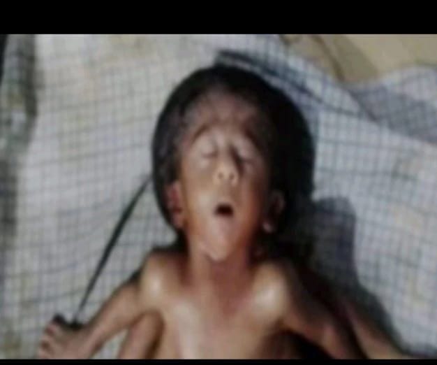 OMG: 4 கை, 4 கால்,2 இதயங்களுடன் பிறந்த குழந்தை… பீகாரில் வினோத சம்பவம்…!!!!!