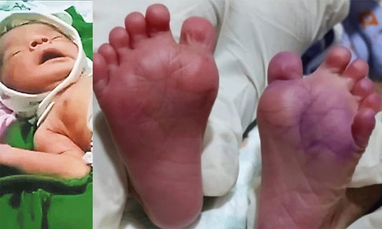25 விரல்களுடன் பிறந்த அதிசய குழந்தை… வியந்துபோன மருத்துவர்கள்…!!!