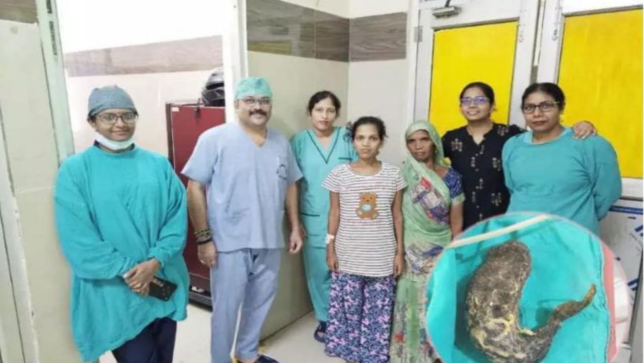 16 வருட ரகசியம்… இளம் பெண்ணின் வயிற்றுக்குள் இருந்த 2 கிலோ முடி… அதிர்ச்சி சம்பவம்…!!