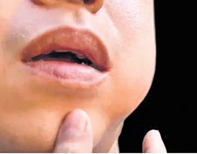தமிழகத்தில் அதிகரிக்கும் Mumps வைரஸ்.. 1091 பேர் பாதிப்பு… இந்த பாதிப்பு இருந்தா எச்சரிக்கையா இருங்க..!!