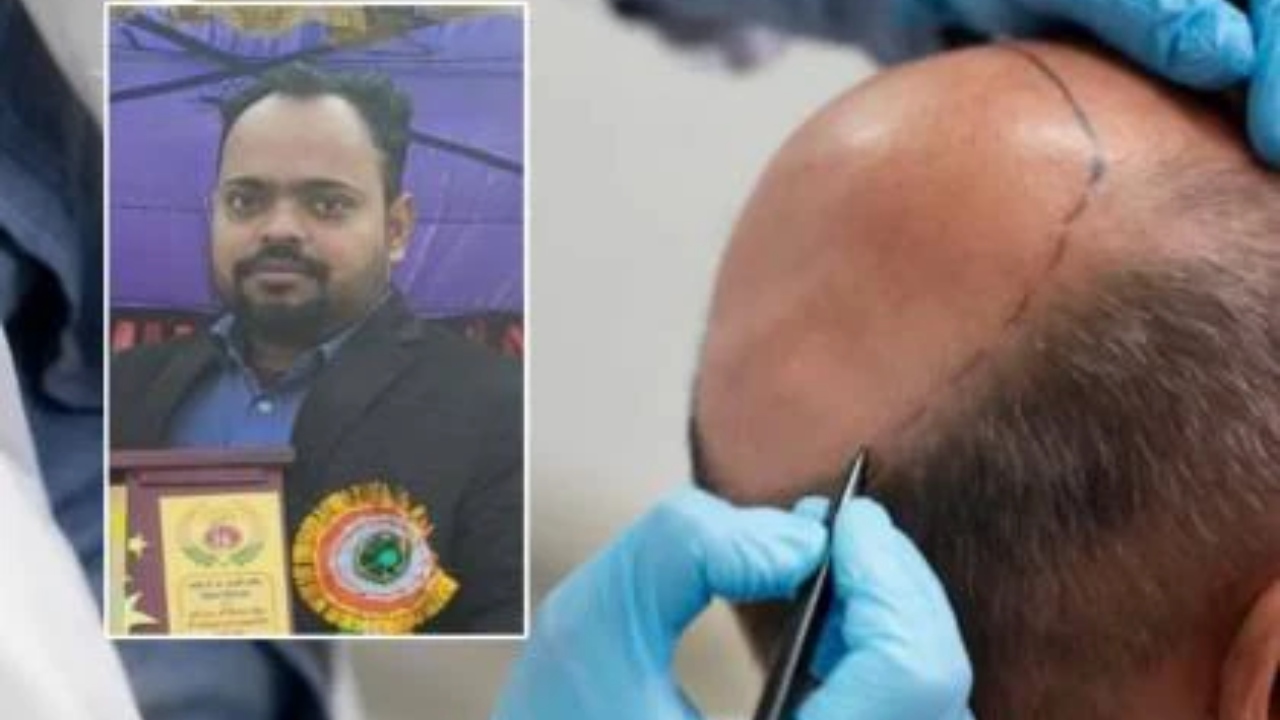 “வழுக்கை தலையில் முடி வளரணும்”… உயிரையே பணயம் வைத்த இளைஞர்… முடிமாற்று அறுவை சிகிச்சையால் வந்த வினை… உயிரே போயிடுச்சு..! ‌