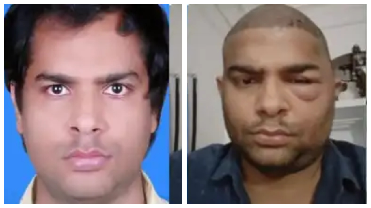 “முடிமாற்று அறுவை சிகிச்சை”…  முகம் வீங்கி பரிதாபமாக உயிரிழந்த இருவர்… டாக்டர் தலைமறைவு… பரபரப்பு சம்பவம்…!!!