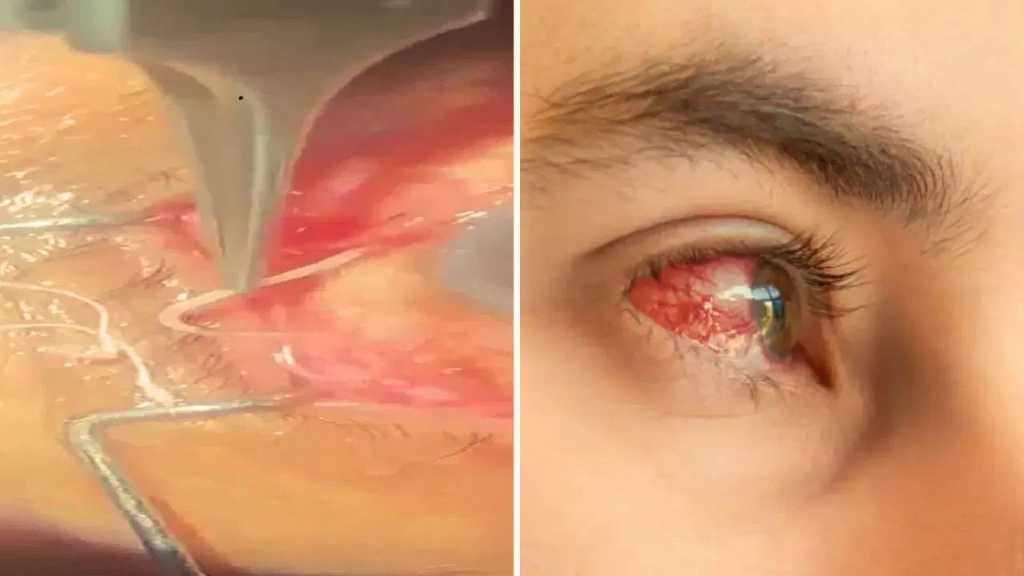OMG: ரத்தக் களறியாக மாறி தீராத எரிச்சல்..! 60 வயது முதியவரின் கண்ணில் 10 செ.மீ நீள புழு… 2 மணி நேரமாக நடந்த ஆபரேஷன்… இப்படியும் நடக்குமா..?