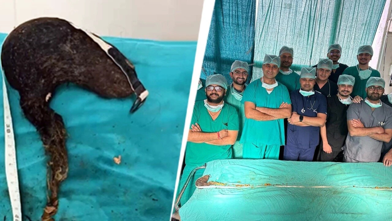ஏம்மா… சாப்பிட வேற எதுவும் இல்லையா…? வலியில் துடித்த 14 வயது சிறுமி…! “வயிற்றில் இருந்த 210 செ.மீ நீளமுள்ள முடி…” போராடி வெற்றி கண்ட மருத்துவர்கள்….!!