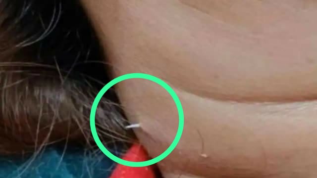அம்மாடியோ…! “மீன் சூப் குடித்த பெண்….” தொண்டையில் சிக்கிய முள்…. கழுத்தை துளைத்து வெளியே வந்த வினோதம்…. பகீர் சம்பவம்….!!