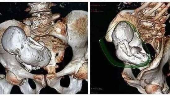 75 வயது மூதாட்டியின் வயிற்றில்… “30 வருஷமாக இருக்கும் கல்லாக மாறிய குழந்தை”… ஆனாலும் உயிரோடுதான் இருக்காங்க… மெய்சிலிர்க்க வைக்கும் தகவல்..!!!!