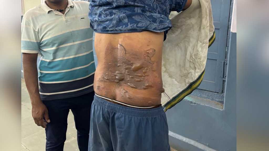 அடியாத்தி…! கொதிக்க கொதிக்க எண்ணெயையும் வெந்நீரையும் கணவன் மீது ஊற்றிய மனைவி”… இரவு முழுவதும் அறையில் பூட்டி வைத்து… கொடூர சம்பவம்…!!!
