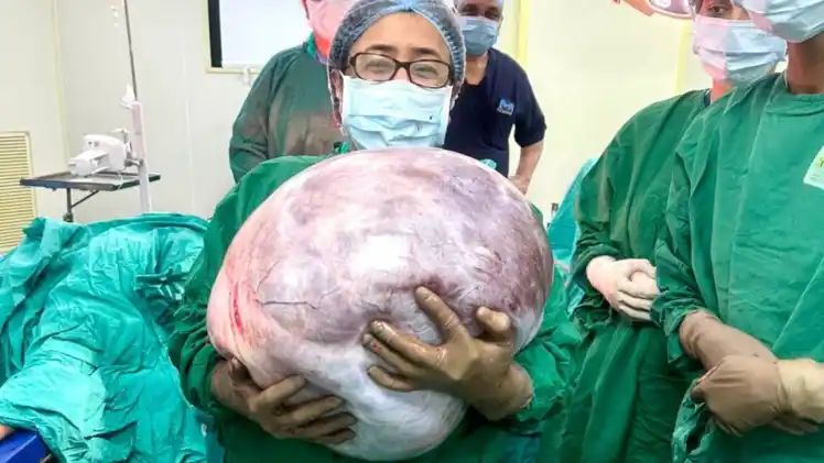 அடேங்கப்பா…! 68 வயது மூதாட்டியின் வயிற்றில் 18 கிலோ கட்டி… 110 கிலோவிலிருந்து 96 கிலோவாக எடை குறைப்பு… வெற்றிகரமாக நடந்த ஆபரேஷன்…!!!