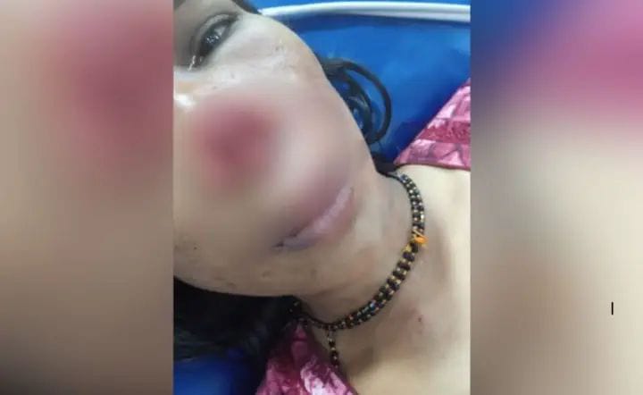 அடக்கொடுமையே..! “தலைக்கேறிய வெறி”… ஆத்திரத்தில் மனைவியின் மூக்கை கடித்து துப்பிய கணவன்… ஒரு சின்ன பிரச்சனைக்காக இப்படியா…?