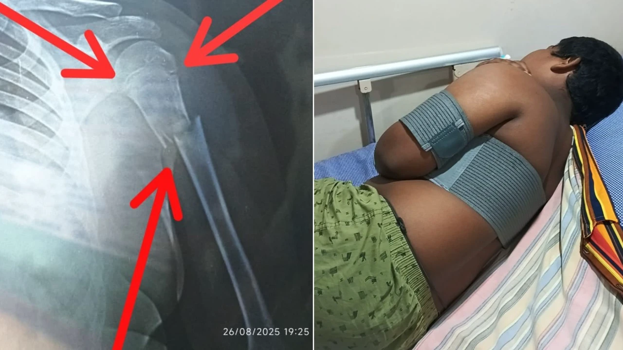 8-ம் வகுப்பு மாணவனை இரும்பு மேசையால் தாக்கிய ஆசிரியர்… கையில் 3 இடத்தில் முறிவு ஏற்பட்டு மருத்துவமனையில் அனுமதி.. அதிர்ச்சி சம்பவம்…!!!