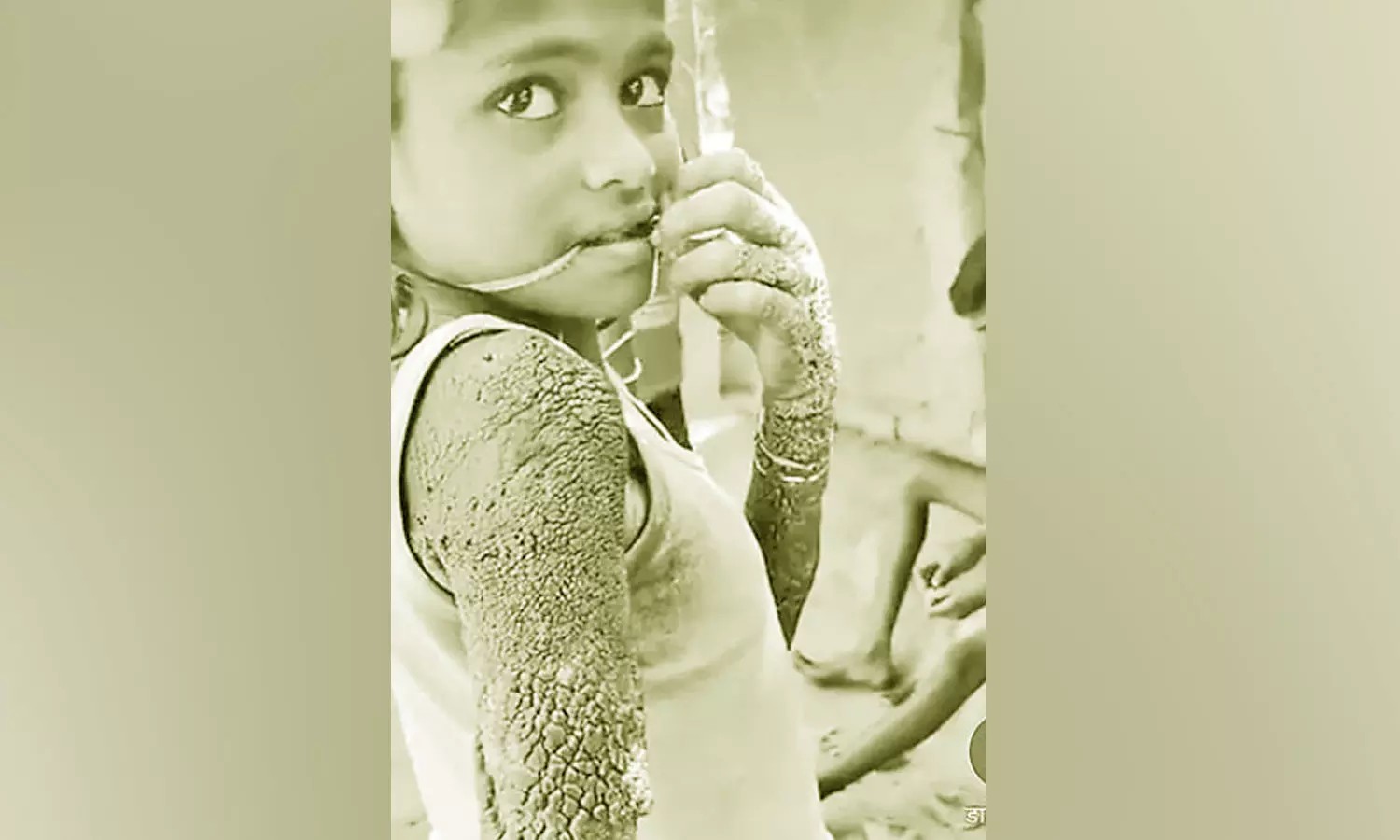 அடக்கடவுளே..! 12 வயசு சிறுமிக்கு இப்படி ஒரு கொடுமையா..? உடல் முழுவதும் கல்லாக மாறிய அதிர்ச்சி… ஏன் இப்படி ஒரு நிலை..!!