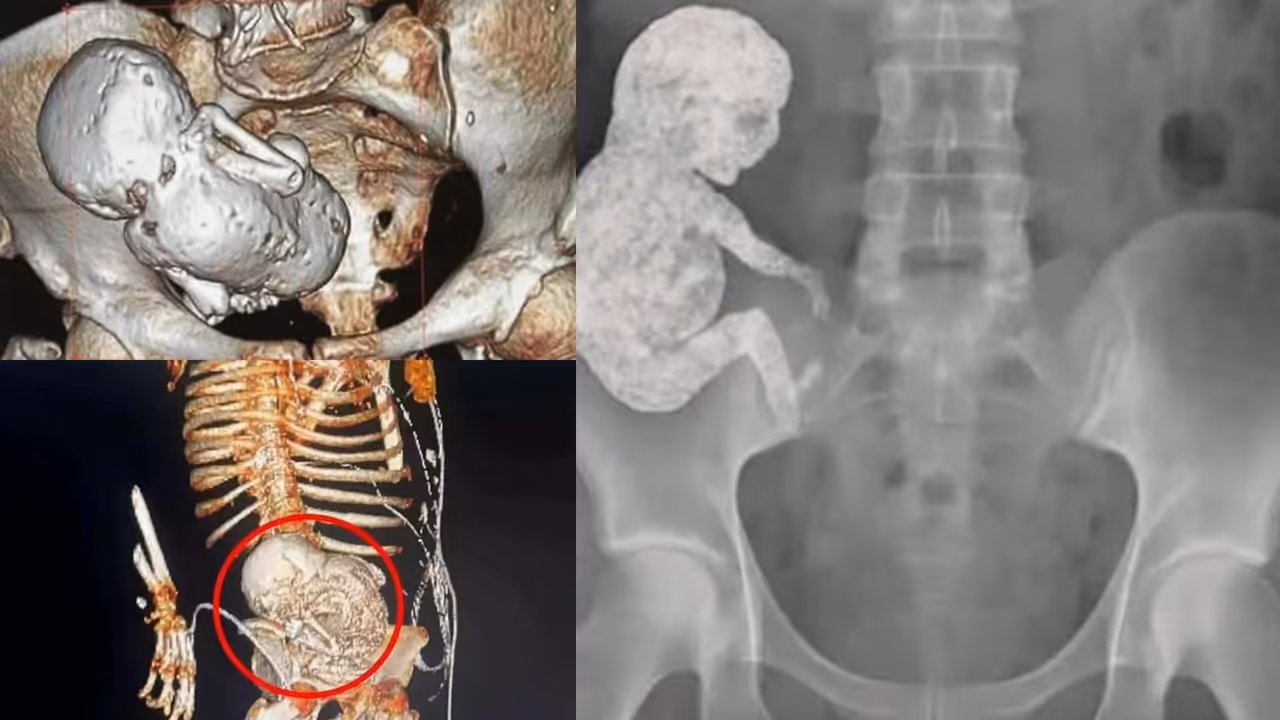 “மெடிக்கல் மிராக்கிள் 40 வருட கருவா?”.. 82 வயது பாட்டியின் வயிற்றில் அதிசயம்.. ஸ்கேன் ரிப்போர்ட்டை பார்த்து மிரண்டு போன மருத்துவர்கள்.. வினோத சம்பவம்..!!