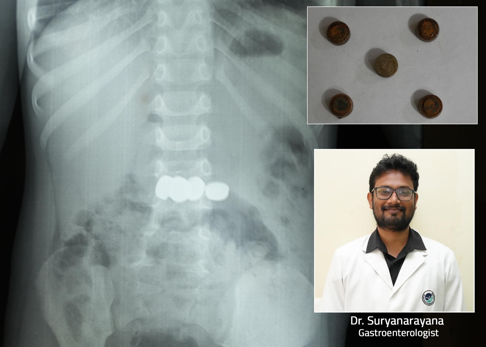 விளையாடிக் கொண்டிருந்தபோது 5 பேட்டரிகளை விழுங்கிய 2 வயது சிறுவன்…. எண்டோஸ்கோபி மூலம் வெளிவந்த உண்மை… பெரும் அதிர்ச்சி…!!!