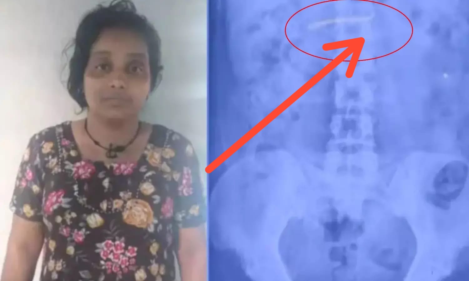 பயங்கரம்.. கொஞ்சியதும் மாயமான தங்கச் சங்கிலி.. பிடிபடுவோம் என்ற பயத்தில் விழுங்கிய நகை.. தனியார் கிளினிக்கில் நடந்த வினோதக் கொள்ளை..!!!
