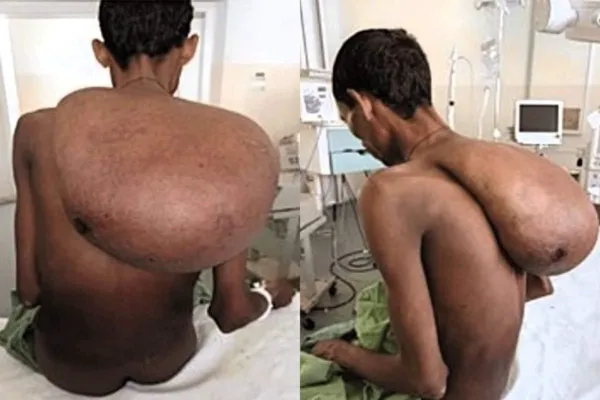 ஃபர்ஸ்ட் எலுமிச்சம் பழம் மாதிரிதான் இருந்தது…! ஆனா திடீரென 25 கிலோ மலைபோல மாறியது… விவசாயியின் வாழ்க்கையை புரட்டி போட்ட கட்டி… மருத்துவ உலகில் வினோதம்..!!