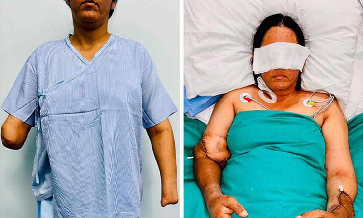 மீண்டும் மருத்துவத்துறையில் ஒரு புதிய சாதனை… 2 கைகளையும் இழந்த பெண்ணுக்கு கிடைத்த புது வாழ்வு…!!!