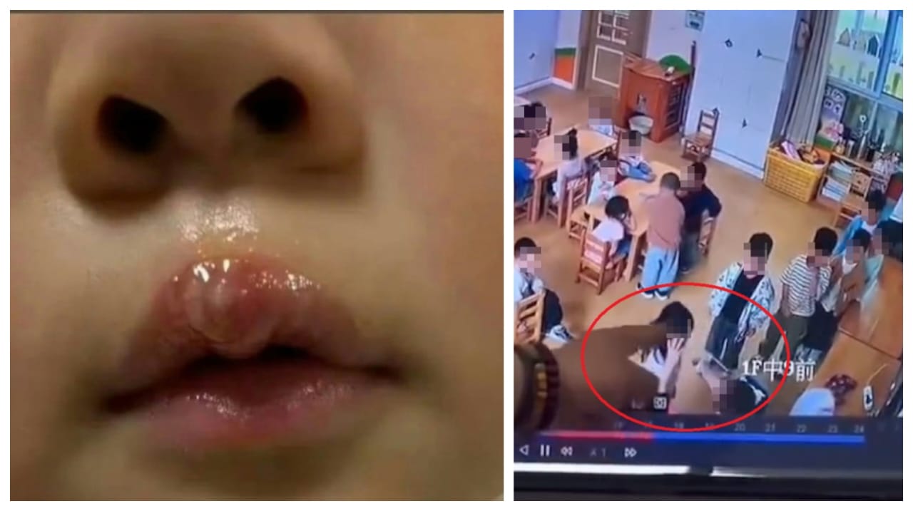 4 வயசு தான் ஆகுது…! “குழந்தையின் உதட்டை பழுக்க வைத்த சைக்கோ டீச்சர்”… மாணவர்களை வரிசையா நிக்க வைத்து தரதரவென இழுத்து… ஸ்கூலில் நடந்த பயங்கரம்…!