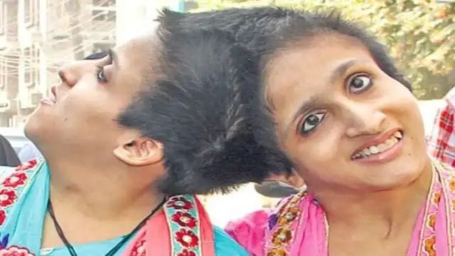 ஒட்டிப்பிறந்த தலை..! உச்ச நீதிமன்றமே உத்தரவு போட்டும் மருந்து கொடுக்கல”.. 23 வருஷமா ஒரே அறையில் முடங்கிய சகோதரிகள்… அண்ணனின் கண்ணீருக்கு அதிகாரிகள் சொன்ன ஒற்றை பதில்…!!!