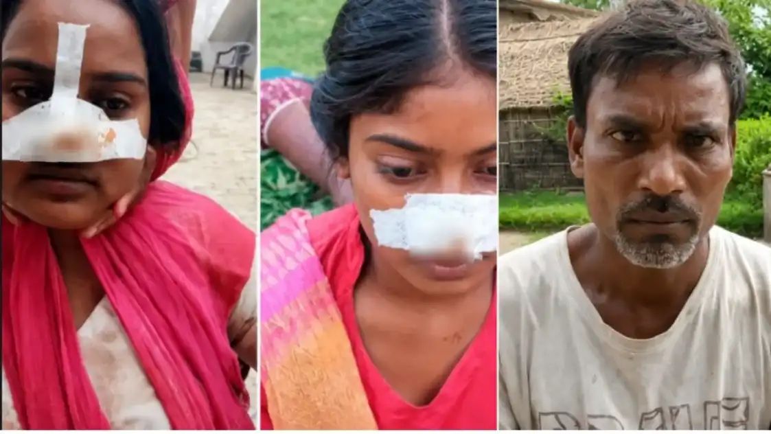 “பெண்டாட்டி மூக்கை கடித்த கணவன்… பதிலுக்கு அவன் தங்கச்சி மூக்கை கடித்த மாமியார்.. பழிக்குப்பழி.. கணவன் – மனைவி குடும்பங்களுக்குள் நடந்த ‘மூக்கு’ யுத்தம்..!!”