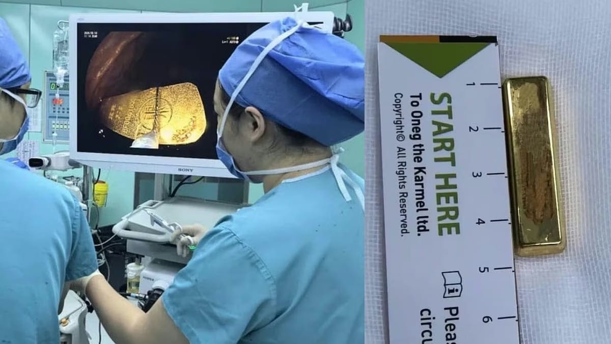 50 கிராம் எடையுள்ள தங்க கட்டி…! அசால்டாக வாயில் போட்டு சாக்லேட் போல விழுங்கிய 5 வயது குழந்தை… பதறி அடித்து ஓடிய பெற்றோர்… திக் திக் நிமிடங்களில் நடந்த ஆபரேஷன்…!