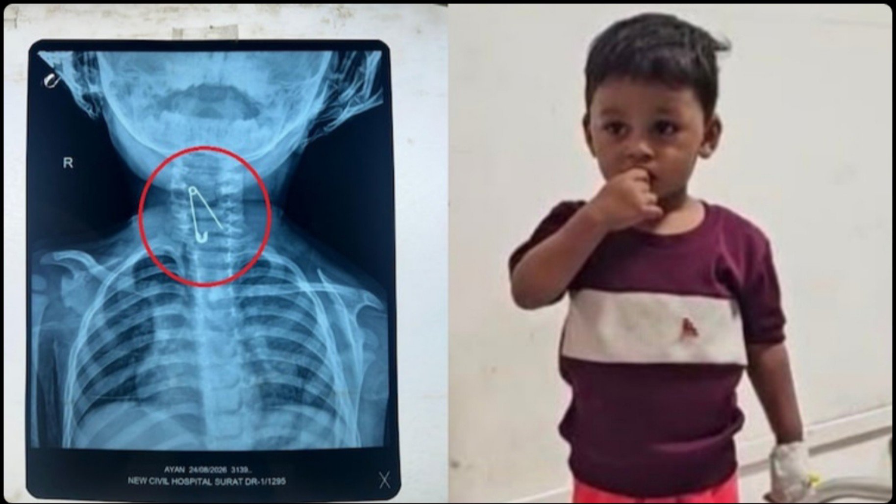 “சேஃப்டி பின்னை விழுங்கிய ஒன்றரை வயது குழந்தை!” – உணவுக் குழாயில் சிக்கிய ஆபத்து… மருத்துவர்கள் செய்த மிராக்கிள் மருத்துவம்…!!”