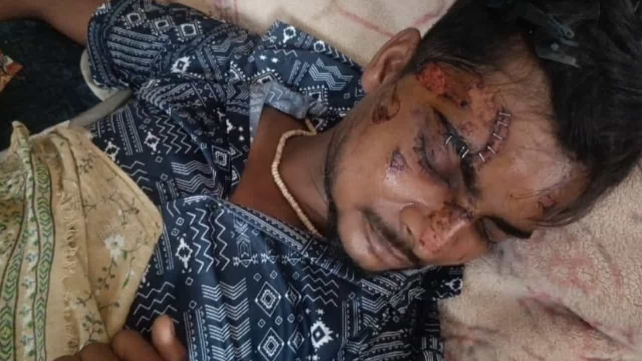 “முகமெல்லாம் ஸ்டேப்ளர் ஊசிகள்!” மோட்டோரோலா போன் வெடித்துச் சிதறியதில் கதறித் துடித்த இளைஞர்… அலிகரில் நடந்த கோர விபத்தால் உறைந்துபோன பொதுமக்கள்…!!”