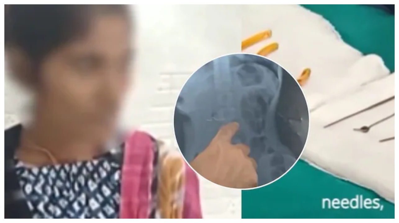 “தையல் ஊசியை முழுங்குற அளவுக்கு இப்படியொரு விசித்திரமான நோயா?” பெண் குடலில் இருந்து 6 ஊசிகளை எடுத்த மருத்துவர்கள்… மருத்துவ உலகை உலுக்கிய அதிர்ச்சி சம்பவம்..!!!