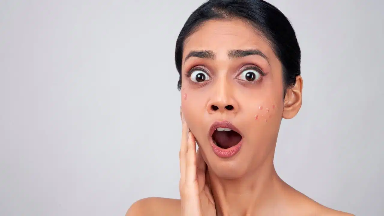 முகப்பரு வந்திருக்கிறதா? அது சாதாரண முகப்பருவாக இருக்க வேண்டிய அவசியமில்லை…! ‘பூஞ்சை முகப்பரு’வா, வழக்கமான முகப்பருவா எப்படி கண்டுபிடிப்பது…? தோல் மருத்துவர் சொல்லும் முக்கிய வித்தியாசங்கள் இதோ…!